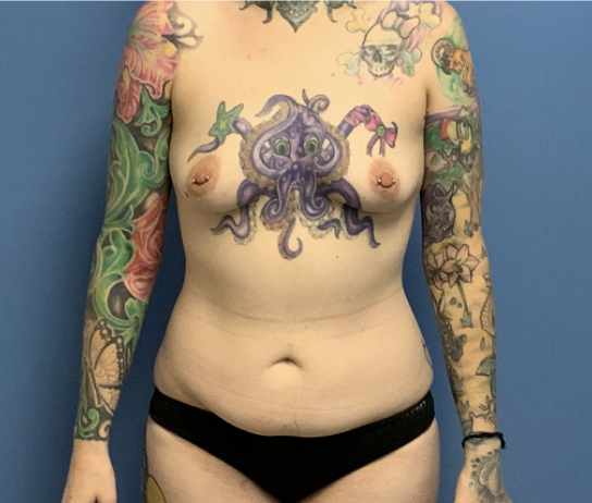 Tummy-Tuck-with-Liposuction--Case-Study-3197 | Before Liposuction